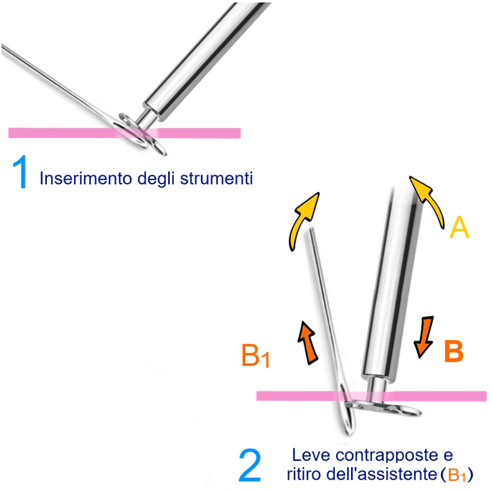 ASSISTENTE per Inseritore Dermal - immagine 3